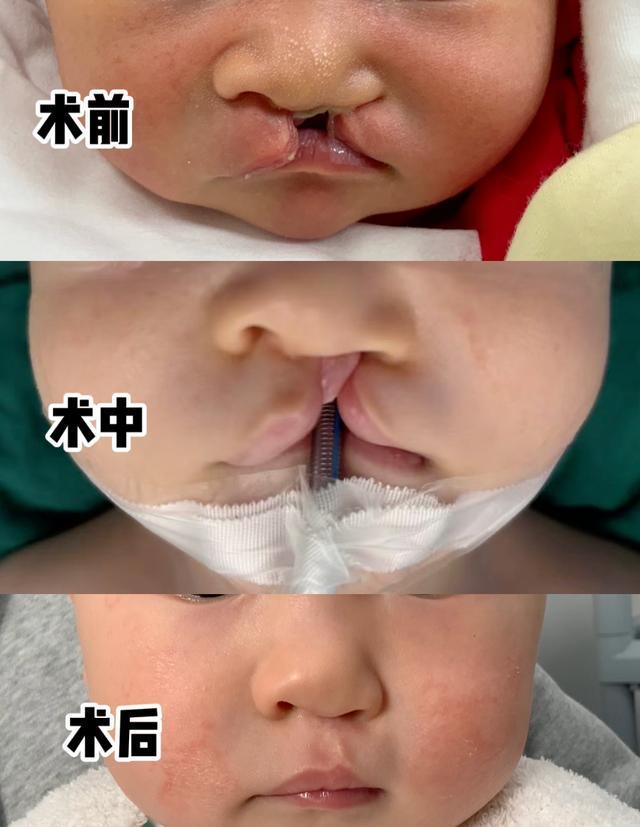 九游娱乐官方入口-对话口腔颌面外科专家陈亦阳：唇腭裂没那么可怕，规范治疗后可与常人无异 | 嫣然医院欠租风波背后